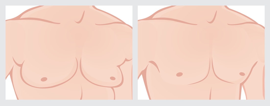 Männerbusen absaugen