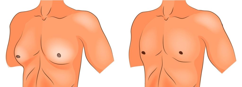 Männerbusen entfernen